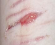 Tw sh- please help I just took my steri strips off by accident and my cuts re opened, I got them put on Monday. Its opened even more compared to the photo. from mandy claire swanson strips off sld cheeta