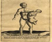 Drawing of Italian omphalopagus parasiticus twins Larazo and Joannes Baptista Colloredo (born 1617). They are drawn naked to show how they were conjoined and how JB&#39;s incomplete body just dangled off his brother Lazaro&#39;s chest. from jb