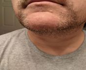 Tried the beard again. Was doing good from July until this week. Might get to keep the stache, but chin is danger area from 155chan july 12