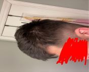What is going on here?? Ive been receding in my temples for about a year now but have been on fin n min n have greatly reduced if not stopped further recession But just recently Ive noticed these patches on the side of my head. Is this balding what ki from star kide dancing what is l6ve