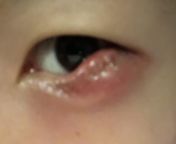 UPDAT3 2: I have a stye &amp; was prescribed polysporin (bacitracin zinc polymyxin B) at urgent care - told to put onto my eyelid and that it’s good to get a bit into my eye. I applied it and now my eyelid is more swollen and painful. I then saw the packa from 聊天室app维护部署不爆毒不反诈飞机：@kxkjww @kxkjrj） zinc