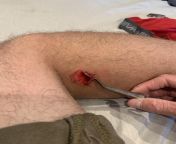 Caught my leg on a bolt at work. Seems to have ripped some skin off and also looks fairly deep. Should I leave it or go to my doctor/ hospital? from doctor hospital sexual sexy xxxx