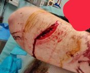 Gore. Why I carry medical at all time. Got into a fight with a glass jar and gate. I lost. I pulled a 3 in piece of glass out and applied Israeli bandage I carry in my pocket. Drove to the hospital got 18 stitches. from lift carry in brazil