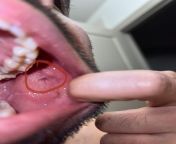 ??31 Male Non smoker No alcohol Active lifestyle Stress and anxiety i do have I noticed a lesion right above the buccall area inside my left cheek. The lesion looks like a blue and red veins. Im afraid this could be bad ?My wisdom tooth have been hurtingfrom redlight area inside room videos