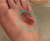 Im receiving a series of alcohol sclerosing injections to kill nerves in my foot.. is it normal to have very bright redness around the injection area? from injection medical femdom