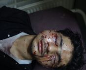 A Shia Muslim with 12 gauge shotgun pellet injuries on his face after Indian police fired at a Maharram procession in Srinagar, Kashmir, blinding and injuring dozens of Kashmiris. from kashmire srinagar kashmiri xxx