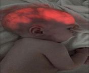 Baby contracted a herpesvirus few days after birth causing brain infection. 90% of brain tissue died. Light behind head showing how much brain is missing from brain jpg
