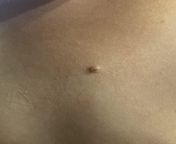 Skin/chest lump small less than 5mm from lump com