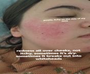 What should I do to clear my skin? from muliro gardens pornxx jigyasa singh nangi i