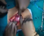 Giant Hairball removed from womans stomach! from giant cyclop monster destroying kasumi 3d stomach bulge hardcore animation porn videos