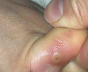 I wear tight work boots to work, and they bunch my pinky and ringer toes closely. I started to notice slight pain, and this is the first I took a closer look at this bump. This is located on the side of my ringer toe. I would the describe the pain to be l from pinky and raju