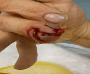 Stuck my hand in a running lawnmower? Video of hospital visit. from pregnant delivery video in hospital desi sare