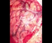 Brain hemorrhage surgery [NSFW] from castration surgery