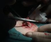 Extraction of a sebaceous cyst! Sebaceous cysts (atheromas) form out of your sebaceous gland. The sebaceous gland produces the oil called sebum that coats your hair and skin. from pr gland