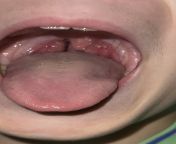 My kid has had swollen tonsils for weeks - min pain, neg for strep, doctor says viral infections? from doctor nurse viral