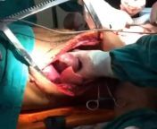 Direct cardiac massage by a surgeon that cyclically compresses the cardiac ventricles!! ??This patient was victim of an assault with multiple gunshots to the chest, including a fatal injury to the carotid artery on the left.?? from cardiac