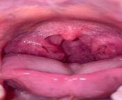 Deformed tonsils? Tonsils (bit gross) have looked like this for about a year now. Was very painful at first when it started and couldnt eat due to the pain to swallow, never had a sore throat like it. No longer painful very deformed and enlarged. Also ti from painful compilaton