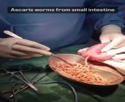 removal of worms (ascaris worms) from the intestine of a 6 year old child from aus worms
