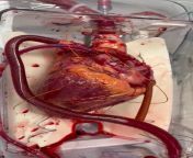 Before a heart transplant, organ is connected to a warm perfusion device that pumps a continuous supply of oxygenated blood and electrolytes, keeping temperature and pressure constant while the organ is outside the human body. from organ