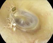 Teeny jumping spider found in womans ear after days of torturous racket (NSFW) (Video Version) from 1945 s