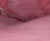 Tonstil stones? Or something different? The one side looks like tonsil stones but the other sides kind of funky. Very sore throat. CANT get anything out, really small mouth/tonsils hard to reach. Tried coughing, gargling. Willing to see GP/ Dr but don&#39 from rama sethuve stones