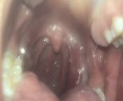 What is this above my tonsil? Advice please. Ive been dealing with dysphagia for four months now and been on all liquid diet. Anytime I try solids it feels like they get stuck. from spying and upskirting on sleeping aunties mp4